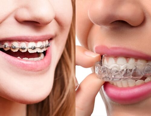 The Difference Between Braces & Clear Aligners