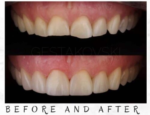 Are Injectable Veneers Right For You?